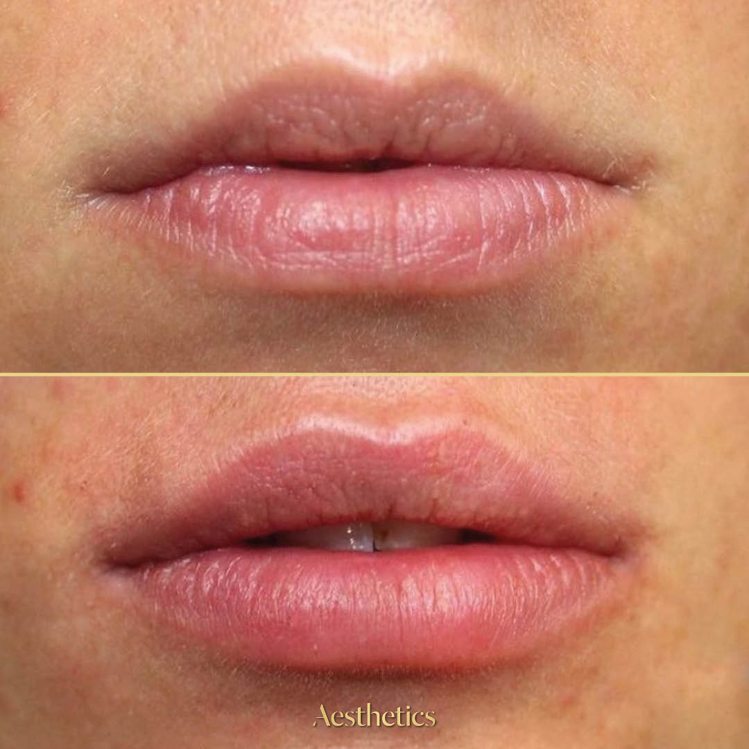 before and after lip fillers