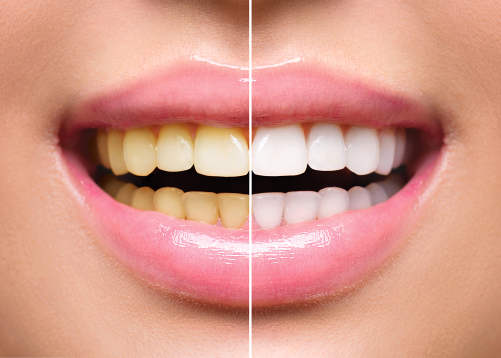 before and after teeth whitening