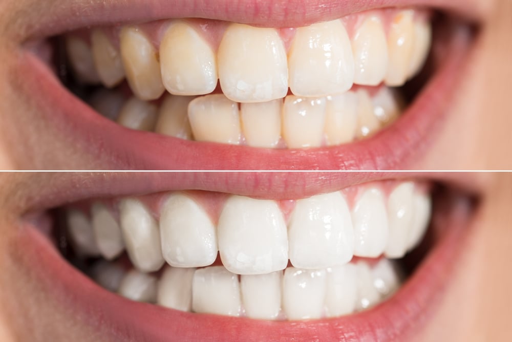 tooth whitening before and after