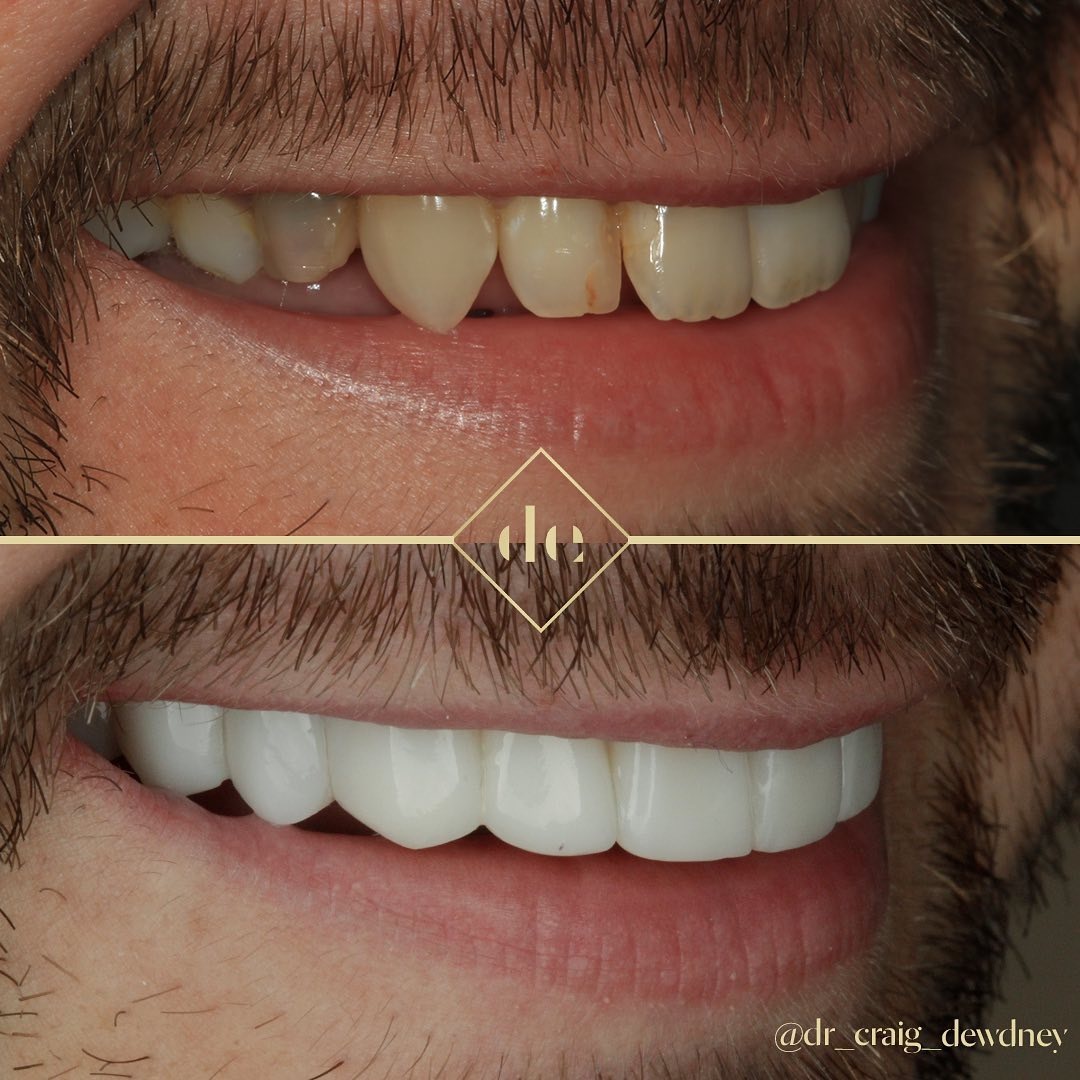 composite veneers before and after