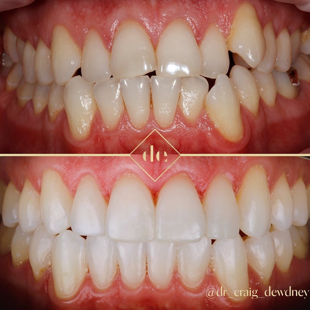 cosmetic or fixed braces before and after teeth