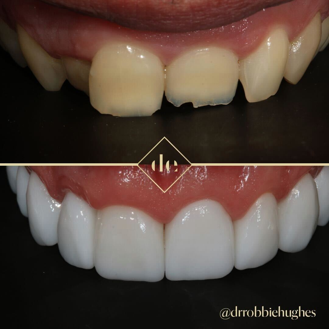 porcelain veneers before and after